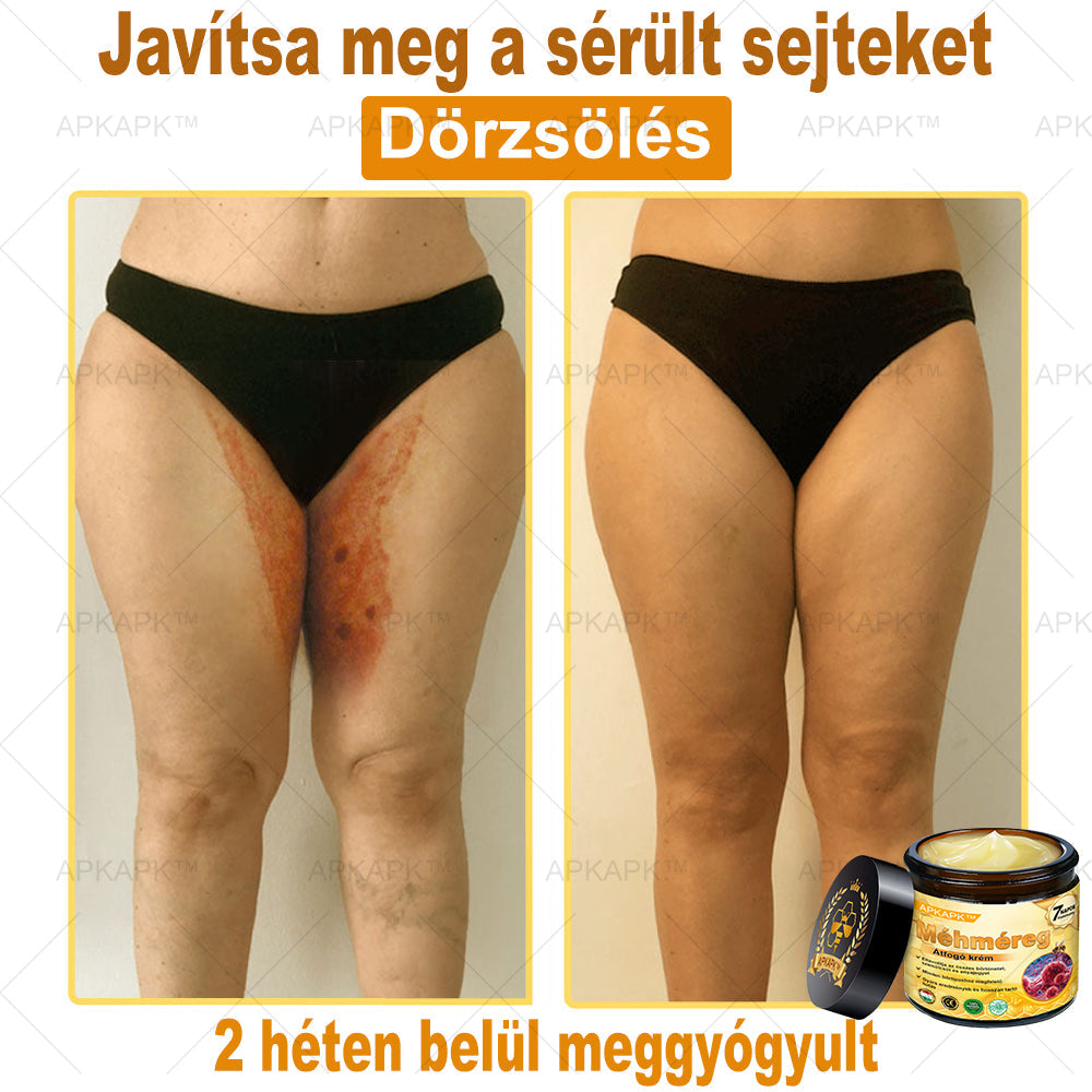 𝐀𝐏𝐊𝐀𝐏𝐊® 𝐌É𝐇𝐌É𝐑𝐄𝐆 Á𝐓𝐅𝐎𝐆Ó 𝐊𝐑É𝐌🥇𝐀 𝐛ö𝐫𝐩𝐫𝐨𝐛𝐥é𝐦á𝐤 𝐤𝐞𝐳𝐞𝐥é𝐬𝐞 𝐦𝐚𝐠á𝐛𝐚𝐧 𝐟𝐨𝐠𝐥𝐚𝐥𝐣𝐚: é𝐥𝐞𝐭𝐤𝐨𝐫𝐢 𝐟𝐨𝐥𝐭𝐨𝐤, 𝐡𝐞𝐠𝐞𝐤, 𝐬𝐳𝐞𝐦ö𝐥𝐜𝐬ö𝐤, 𝐛ö𝐫𝐧ö𝐯𝐞𝐝é𝐤𝐞𝐤, 𝐭á𝐥𝐲𝐨𝐠𝐨𝐤, 𝐩𝐚𝐭𝐭𝐚𝐧á𝐬𝐨𝐤, 𝐞𝐤𝐜é𝐦𝐚, 𝐩𝐬𝐨𝐫𝐢𝐚𝐬𝐢𝐬, 𝐚𝐜𝐧𝐞 𝐢𝐧𝐯𝐞𝐫𝐬𝐚, 𝐫á𝐧𝐜𝐨𝐤, 𝐛ö𝐫ö𝐫𝐞𝐠𝐞𝐝é𝐬 é𝐬 𝐞𝐠𝐲é𝐛 𝐩𝐫𝐨𝐛𝐥é𝐦á𝐤✅