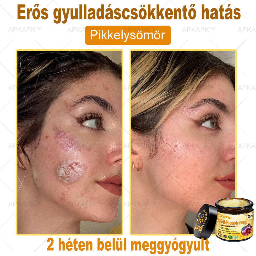 𝐀𝐏𝐊𝐀𝐏𝐊® 𝐌É𝐇𝐌É𝐑𝐄𝐆 Á𝐓𝐅𝐎𝐆Ó 𝐊𝐑É𝐌🥇𝐀 𝐛ö𝐫𝐩𝐫𝐨𝐛𝐥é𝐦á𝐤 𝐤𝐞𝐳𝐞𝐥é𝐬𝐞 𝐦𝐚𝐠á𝐛𝐚𝐧 𝐟𝐨𝐠𝐥𝐚𝐥𝐣𝐚: é𝐥𝐞𝐭𝐤𝐨𝐫𝐢 𝐟𝐨𝐥𝐭𝐨𝐤, 𝐡𝐞𝐠𝐞𝐤, 𝐬𝐳𝐞𝐦ö𝐥𝐜𝐬ö𝐤, 𝐛ö𝐫𝐧ö𝐯𝐞𝐝é𝐤𝐞𝐤, 𝐭á𝐥𝐲𝐨𝐠𝐨𝐤, 𝐩𝐚𝐭𝐭𝐚𝐧á𝐬𝐨𝐤, 𝐞𝐤𝐜é𝐦𝐚, 𝐩𝐬𝐨𝐫𝐢𝐚𝐬𝐢𝐬, 𝐚𝐜𝐧𝐞 𝐢𝐧𝐯𝐞𝐫𝐬𝐚, 𝐫á𝐧𝐜𝐨𝐤, 𝐛ö𝐫ö𝐫𝐞𝐠𝐞𝐝é𝐬 é𝐬 𝐞𝐠𝐲é𝐛 𝐩𝐫𝐨𝐛𝐥é𝐦á𝐤✅