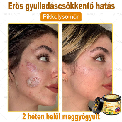 𝐀𝐏𝐊𝐀𝐏𝐊® 𝐌É𝐇𝐌É𝐑𝐄𝐆 Á𝐓𝐅𝐎𝐆Ó 𝐊𝐑É𝐌🥇𝐀 𝐛ö𝐫𝐩𝐫𝐨𝐛𝐥é𝐦á𝐤 𝐤𝐞𝐳𝐞𝐥é𝐬𝐞 𝐦𝐚𝐠á𝐛𝐚𝐧 𝐟𝐨𝐠𝐥𝐚𝐥𝐣𝐚: é𝐥𝐞𝐭𝐤𝐨𝐫𝐢 𝐟𝐨𝐥𝐭𝐨𝐤, 𝐡𝐞𝐠𝐞𝐤, 𝐬𝐳𝐞𝐦ö𝐥𝐜𝐬ö𝐤, 𝐛ö𝐫𝐧ö𝐯𝐞𝐝é𝐤𝐞𝐤, 𝐭á𝐥𝐲𝐨𝐠𝐨𝐤, 𝐩𝐚𝐭𝐭𝐚𝐧á𝐬𝐨𝐤, 𝐞𝐤𝐜é𝐦𝐚, 𝐩𝐬𝐨𝐫𝐢𝐚𝐬𝐢𝐬, 𝐚𝐜𝐧𝐞 𝐢𝐧𝐯𝐞𝐫𝐬𝐚, 𝐫á𝐧𝐜𝐨𝐤, 𝐛ö𝐫ö𝐫𝐞𝐠𝐞𝐝é𝐬 é𝐬 𝐞𝐠𝐲é𝐛 𝐩𝐫𝐨𝐛𝐥é𝐦á𝐤✅