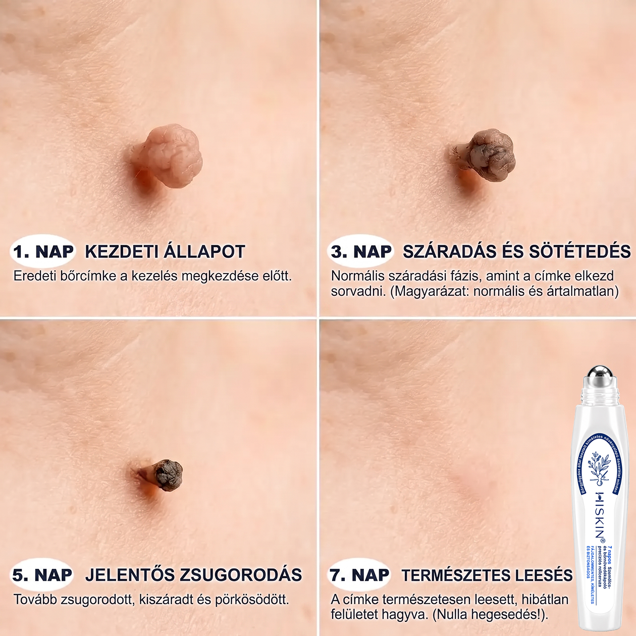 🎁 Hiskin® 7 napos Szemölcseltávolító Roll-on Ápoló Folyadék