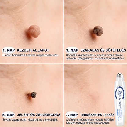 🎁 Hiskin® 7 napos Szemölcseltávolító Roll-on Ápoló Folyadék