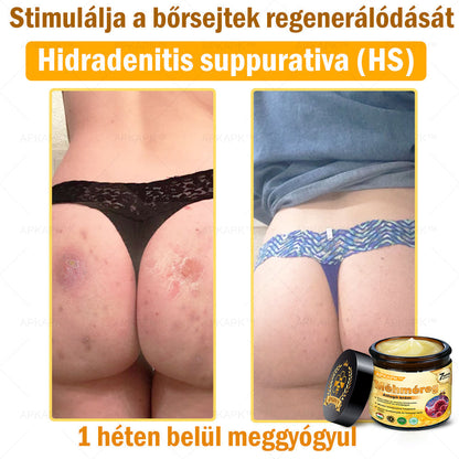𝐀𝐏𝐊𝐀𝐏𝐊® 𝐌É𝐇𝐌É𝐑𝐄𝐆 Á𝐓𝐅𝐎𝐆Ó 𝐊𝐑É𝐌🥇𝐀 𝐛ö𝐫𝐩𝐫𝐨𝐛𝐥é𝐦á𝐤 𝐤𝐞𝐳𝐞𝐥é𝐬𝐞 𝐦𝐚𝐠á𝐛𝐚𝐧 𝐟𝐨𝐠𝐥𝐚𝐥𝐣𝐚: é𝐥𝐞𝐭𝐤𝐨𝐫𝐢 𝐟𝐨𝐥𝐭𝐨𝐤, 𝐡𝐞𝐠𝐞𝐤, 𝐬𝐳𝐞𝐦ö𝐥𝐜𝐬ö𝐤, 𝐛ö𝐫𝐧ö𝐯𝐞𝐝é𝐤𝐞𝐤, 𝐭á𝐥𝐲𝐨𝐠𝐨𝐤, 𝐩𝐚𝐭𝐭𝐚𝐧á𝐬𝐨𝐤, 𝐞𝐤𝐜é𝐦𝐚, 𝐩𝐬𝐨𝐫𝐢𝐚𝐬𝐢𝐬, 𝐚𝐜𝐧𝐞 𝐢𝐧𝐯𝐞𝐫𝐬𝐚, 𝐫á𝐧𝐜𝐨𝐤, 𝐛ö𝐫ö𝐫𝐞𝐠𝐞𝐝é𝐬 é𝐬 𝐞𝐠𝐲é𝐛 𝐩𝐫𝐨𝐛𝐥é𝐦á𝐤✅