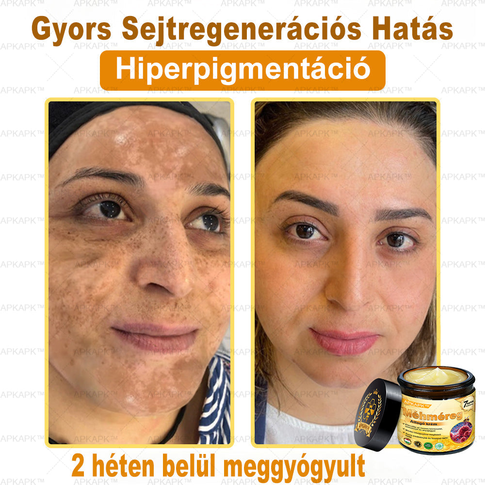 𝐀𝐏𝐊𝐀𝐏𝐊® 𝐌É𝐇𝐌É𝐑𝐄𝐆 Á𝐓𝐅𝐎𝐆Ó 𝐊𝐑É𝐌🥇𝐀 𝐛ö𝐫𝐩𝐫𝐨𝐛𝐥é𝐦á𝐤 𝐤𝐞𝐳𝐞𝐥é𝐬𝐞 𝐦𝐚𝐠á𝐛𝐚𝐧 𝐟𝐨𝐠𝐥𝐚𝐥𝐣𝐚: é𝐥𝐞𝐭𝐤𝐨𝐫𝐢 𝐟𝐨𝐥𝐭𝐨𝐤, 𝐡𝐞𝐠𝐞𝐤, 𝐬𝐳𝐞𝐦ö𝐥𝐜𝐬ö𝐤, 𝐛ö𝐫𝐧ö𝐯𝐞𝐝é𝐤𝐞𝐤, 𝐭á𝐥𝐲𝐨𝐠𝐨𝐤, 𝐩𝐚𝐭𝐭𝐚𝐧á𝐬𝐨𝐤, 𝐞𝐤𝐜é𝐦𝐚, 𝐩𝐬𝐨𝐫𝐢𝐚𝐬𝐢𝐬, 𝐚𝐜𝐧𝐞 𝐢𝐧𝐯𝐞𝐫𝐬𝐚, 𝐫á𝐧𝐜𝐨𝐤, 𝐛ö𝐫ö𝐫𝐞𝐠𝐞𝐝é𝐬 é𝐬 𝐞𝐠𝐲é𝐛 𝐩𝐫𝐨𝐛𝐥é𝐦á𝐤✅