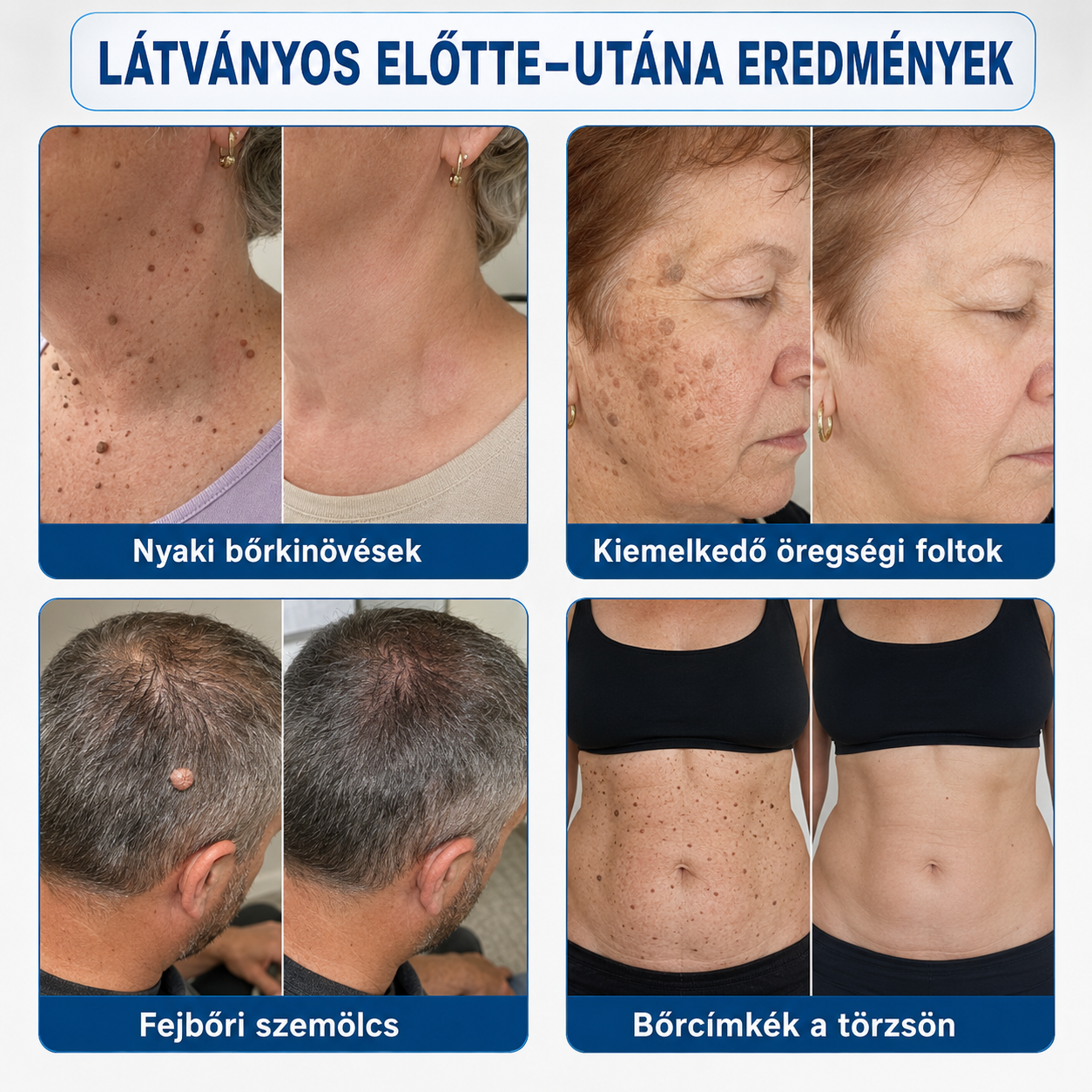 🎁 Hiskin® 7 napos Szemölcseltávolító Roll-on Ápoló Folyadék