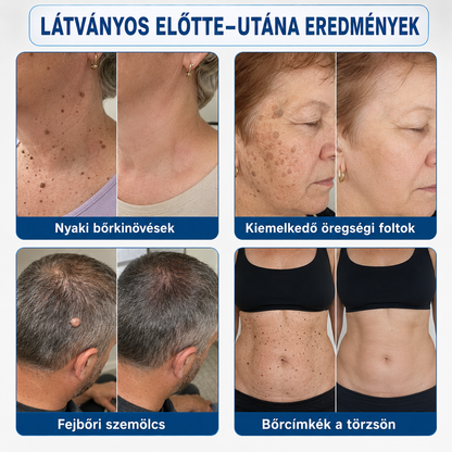 🎁 Hiskin® 7 napos Szemölcseltávolító Roll-on Ápoló Folyadék