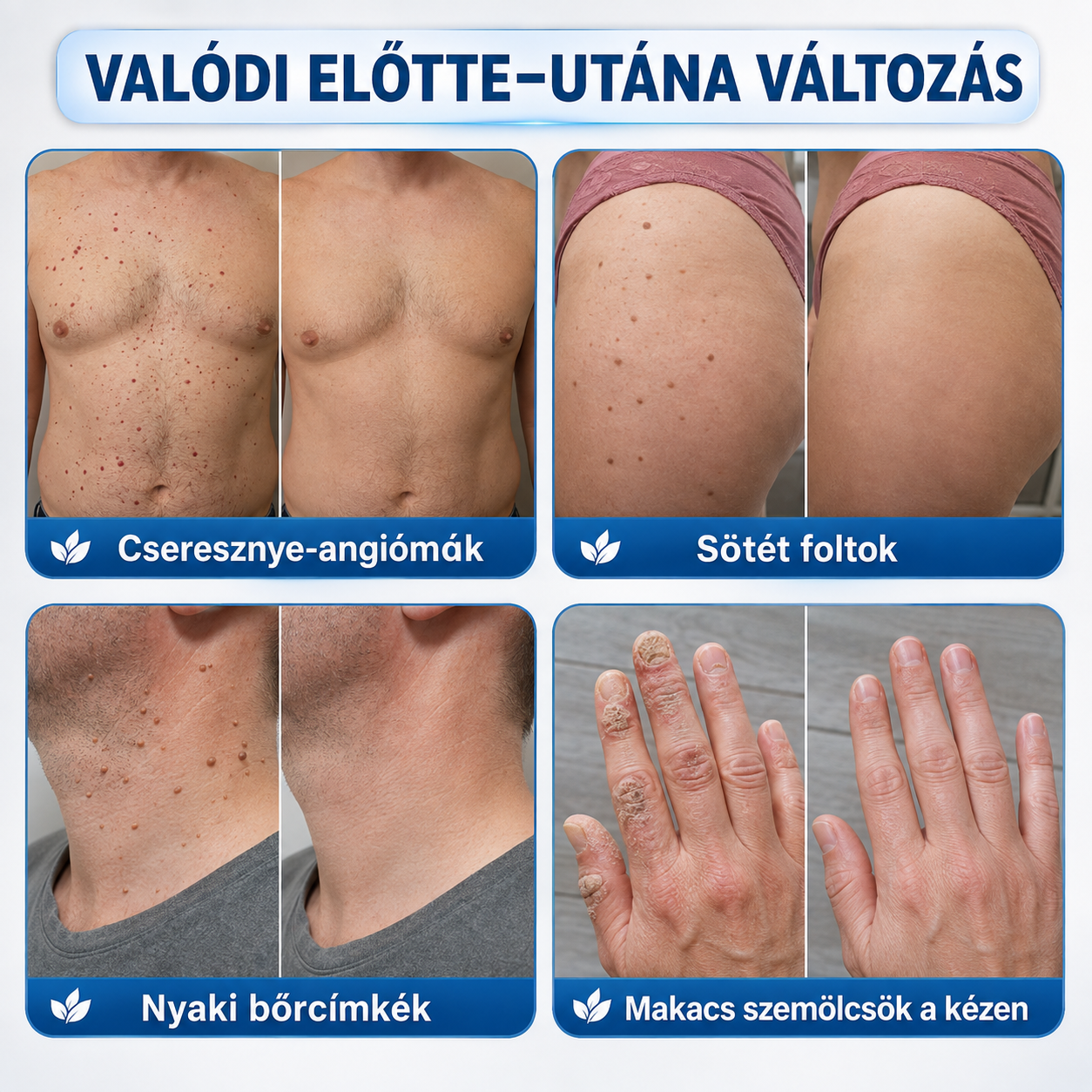 🎁 Hiskin® 7 napos Szemölcseltávolító Roll-on Ápoló Folyadék