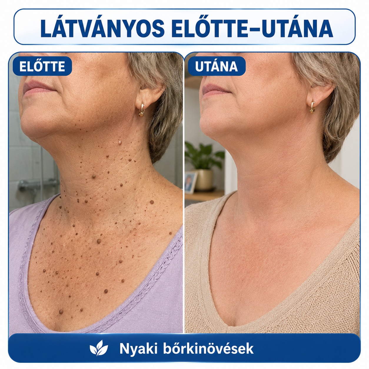 🎁 Hiskin® 7 napos Szemölcseltávolító Roll-on Ápoló Folyadék