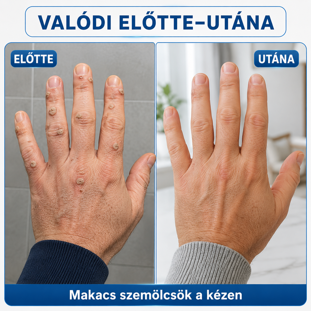 🎁 Hiskin® 7 napos Szemölcseltávolító Roll-on Ápoló Folyadék