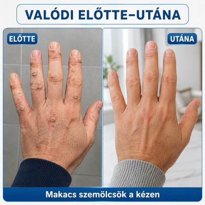 🎁 Hiskin® 7 napos Szemölcseltávolító Roll-on Ápoló Folyadék